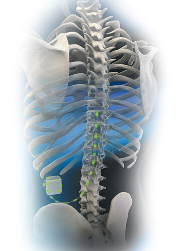 Bildliche Darstellung eines Skeletts mit einem Schrittmacher, der Impulse an das Rückenmark sendet