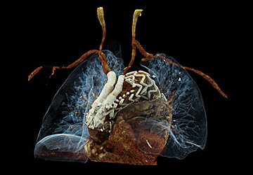 aortenbogenstent