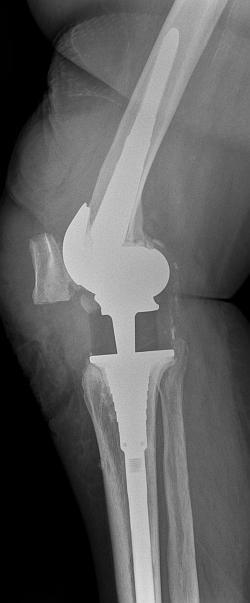 Röntgenbild nach der OP, seitlich